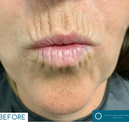 Does Plexr Really Work? Your Complete Guide to Plasma Soft Surgery for Excess Skin and More