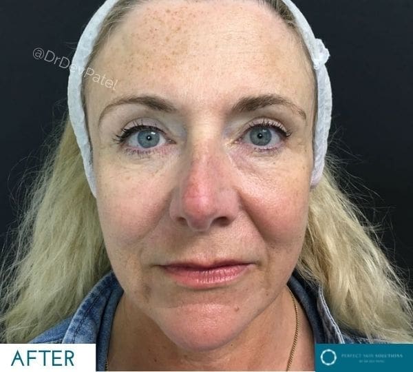 skin tightening treatment after