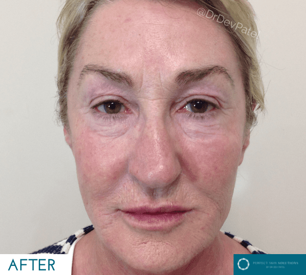 Non-surgical facelift treatment after