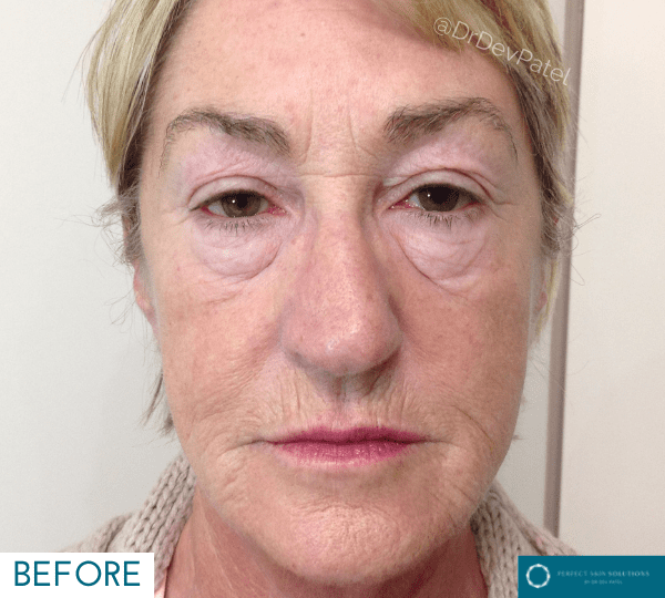 Non-surgical facelift treatment before