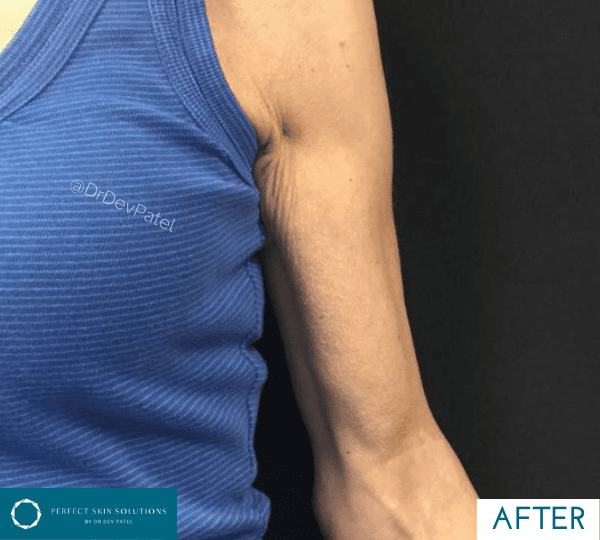 Morpheus8 skin tightening treatment on arm after