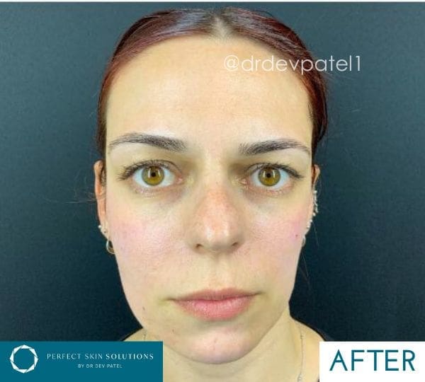 after fillers