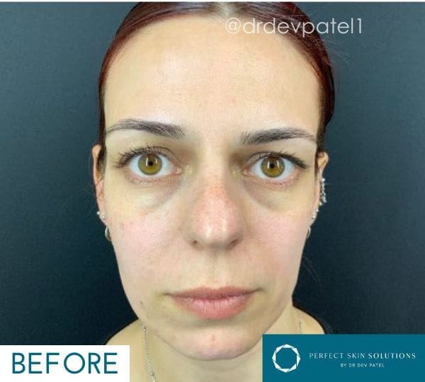 before fillers