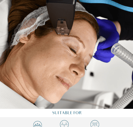 RF Treatment for Cellulite