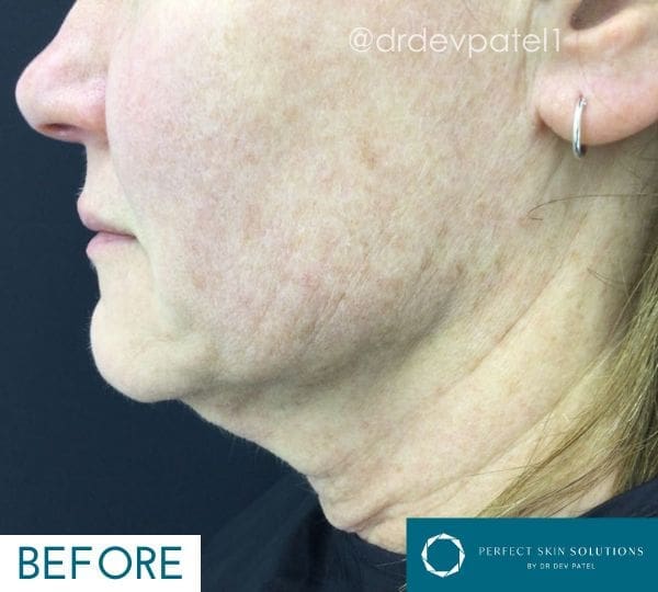 morpheus8 treatment before