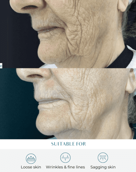 non surgical facelift