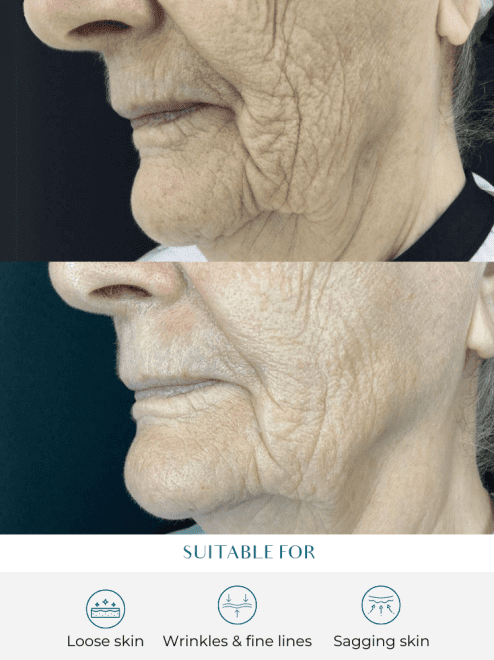 non surgical facelift