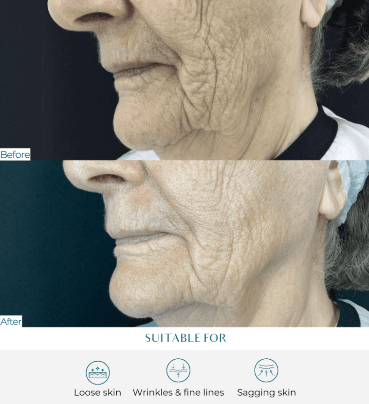 non surgical facelift