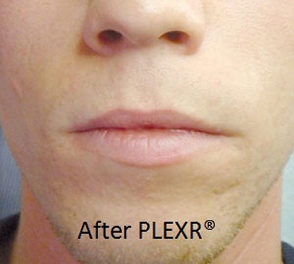 plexr plus treatment after