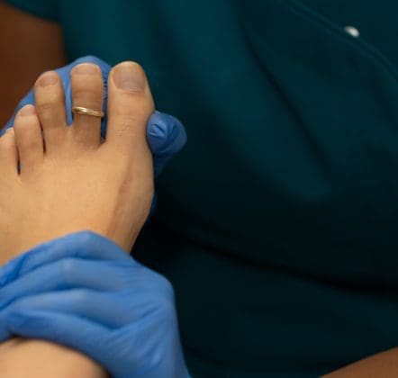 Verruca On Foot Removal: Complete Guide