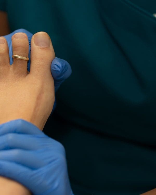 Verruca On Foot Removal: Complete Guide