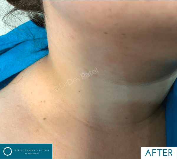 skin surgery treatment after