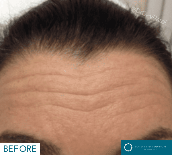 Botox forehead injections with a woman.