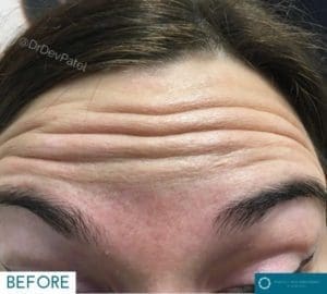 Anti-wrinkle injections botox