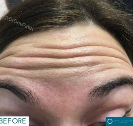 Best Treatment for Wrinkles on Forehead: Expert Solutions at Perfect Skin Solutions