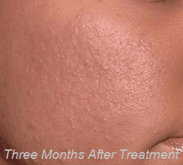 microneedling after