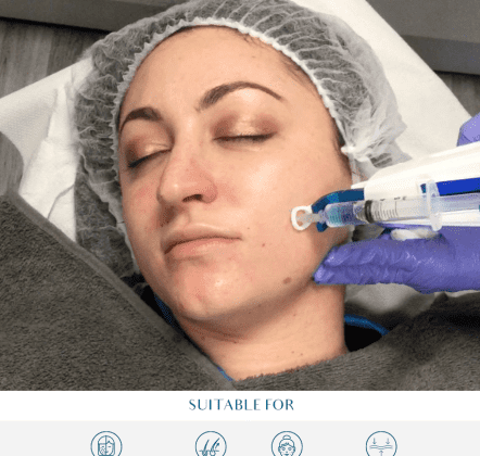 Mesotherapy Hair Cost: What to Expect at Perfect Skin Solutions