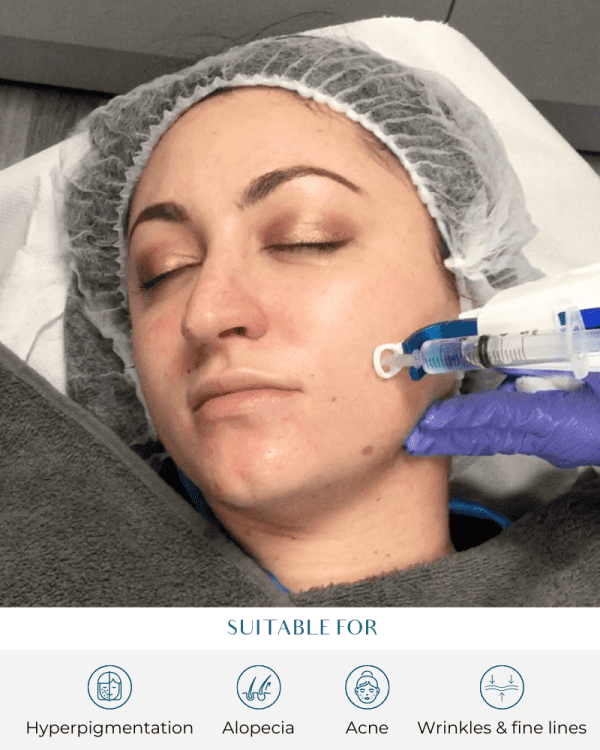 Mesotherapy Hair Cost: What to Expect at Perfect Skin Solutions