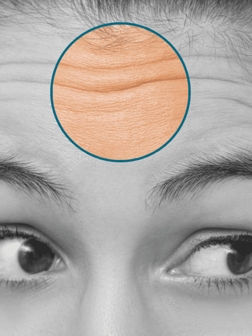 forehead lines highlighted on a model