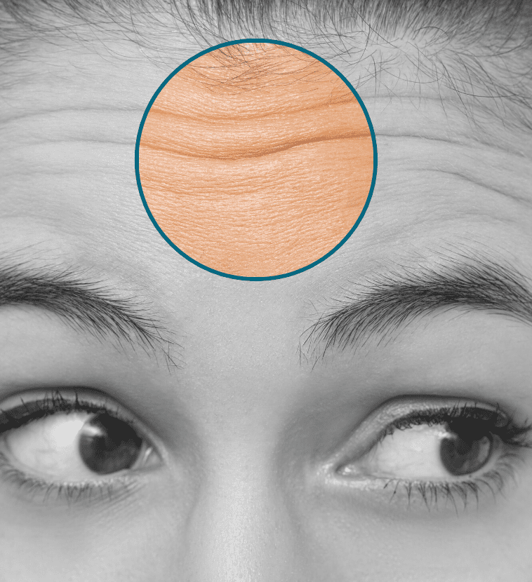 forehead lines highlighted on a model