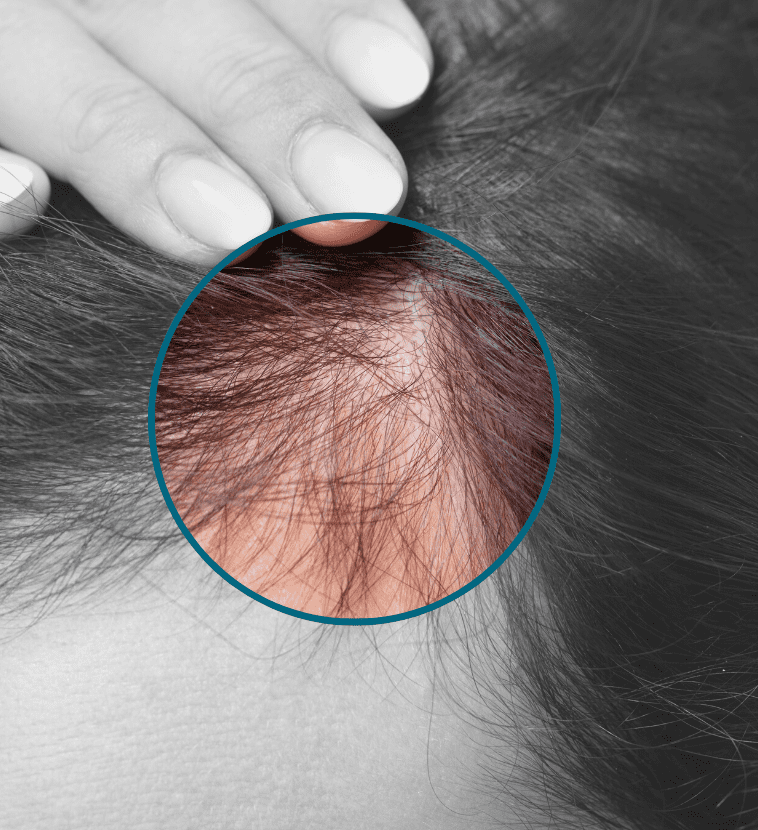 signs of hair loss