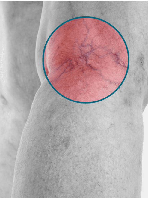 thread veins highlighted on a patients leg