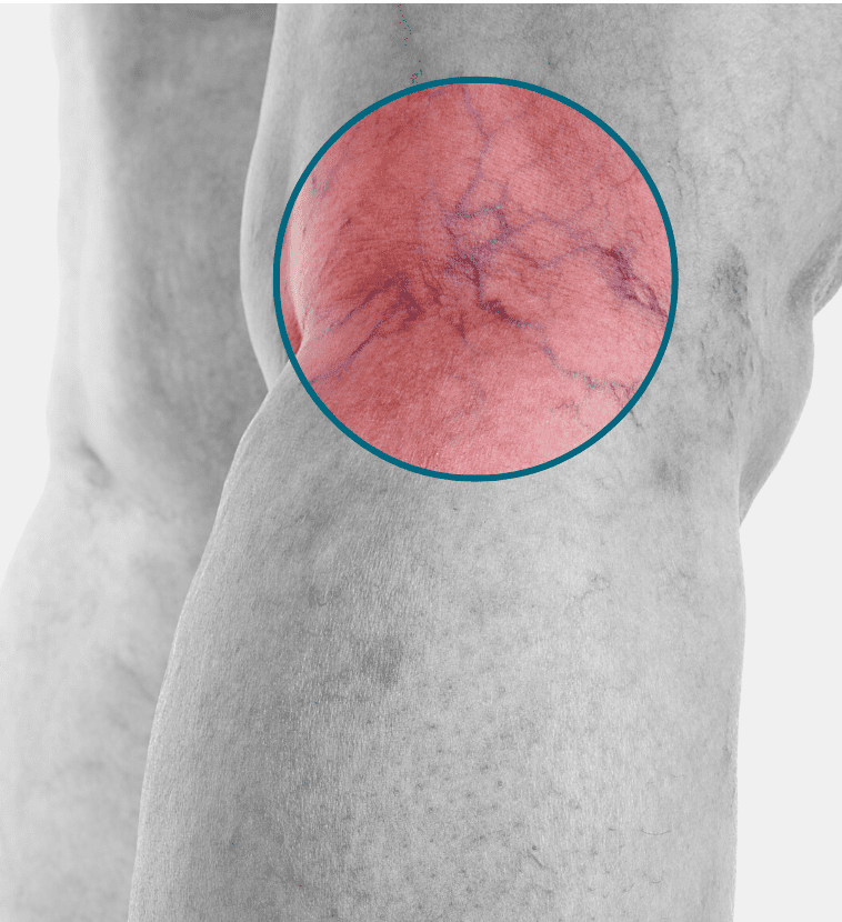 thread veins highlighted on a patients leg