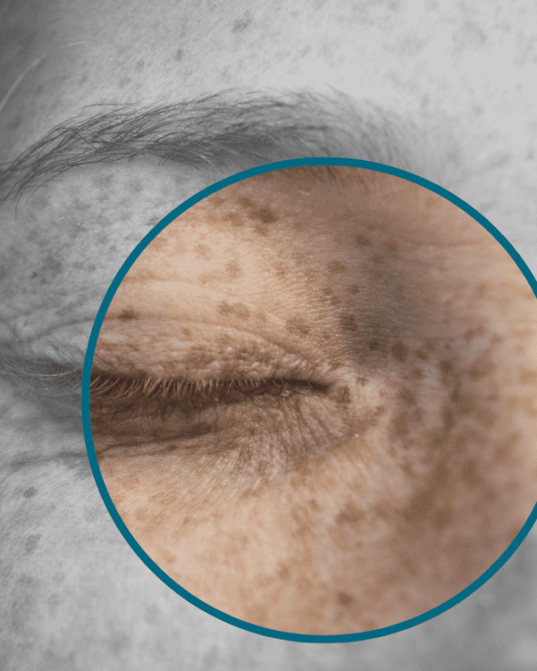 Understanding Pigmentation on Neck: Causes & Treatment Options