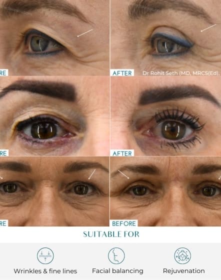 eye lift before and after