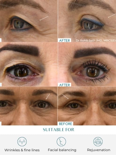 eye lift before and after