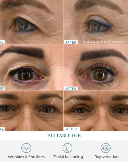 blepharoplasty eye surgery