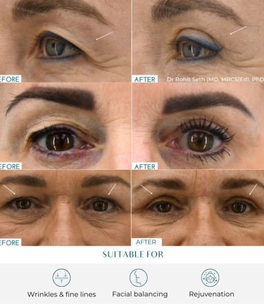 Eyelid Lift