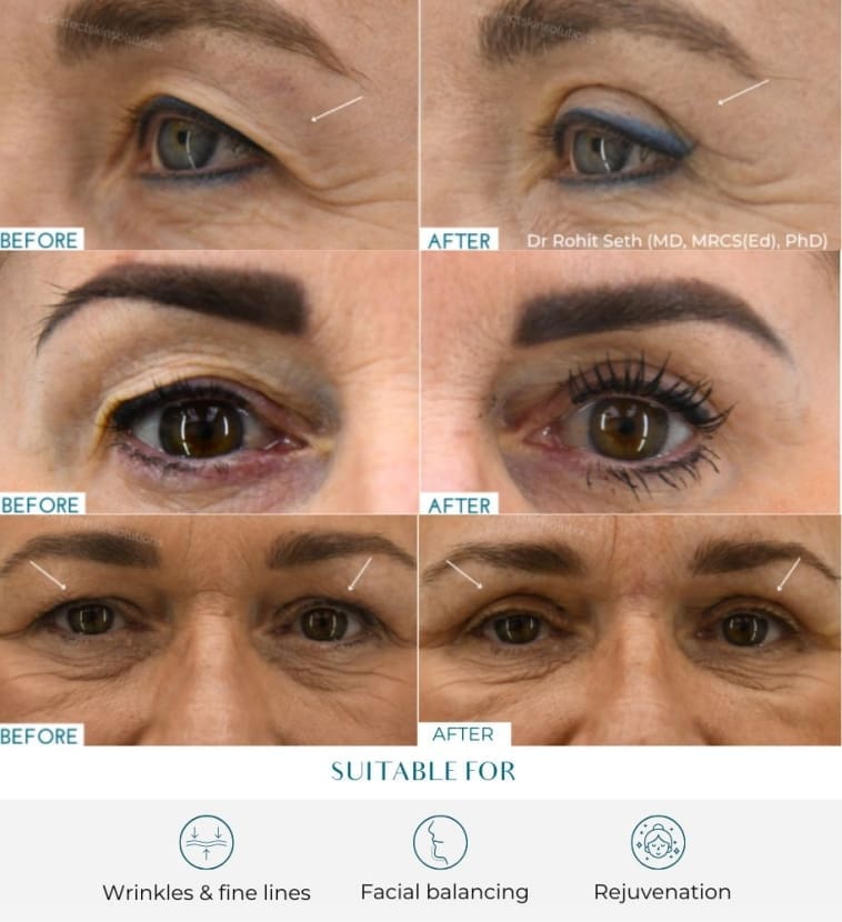 blepharoplasty eye surgery