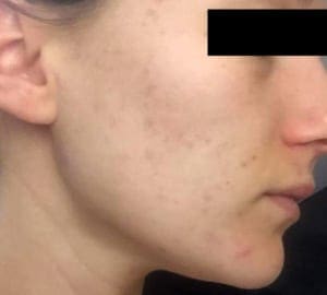 chemical peels after treatment