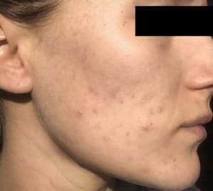 chemical peels before treatment