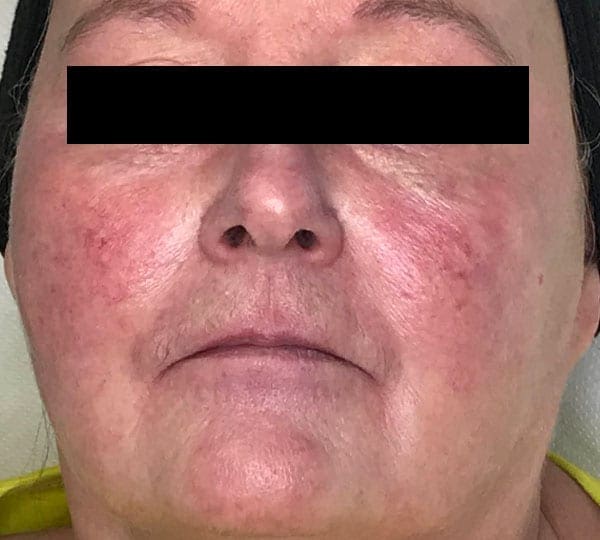 chemical peels after treatment