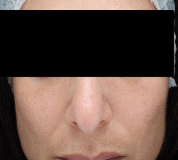 chemical peel after treatment