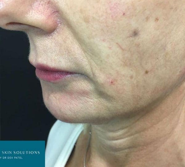 jaw filler treatment after