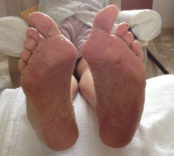 chiropody treatment after