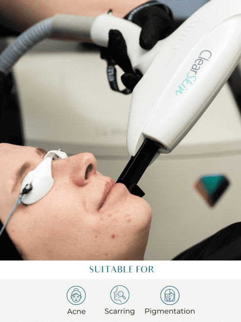 patient being treated with clearskin machine