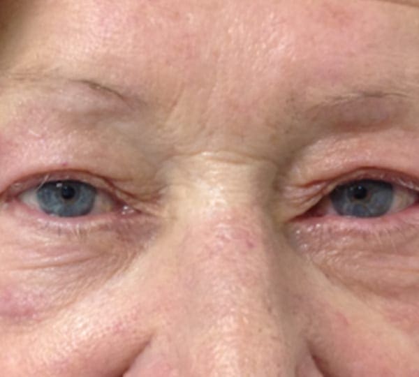 eyelid lift treatment after