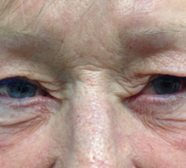 eyelid lift treatment before