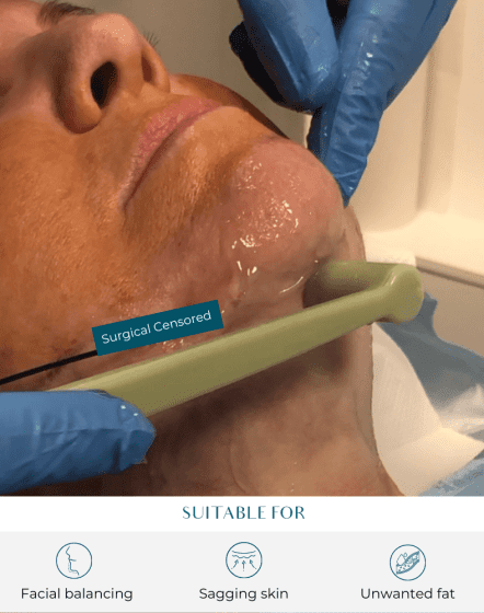 facetite procedure