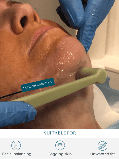 facetite procedure