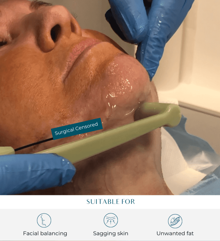 facetite procedure