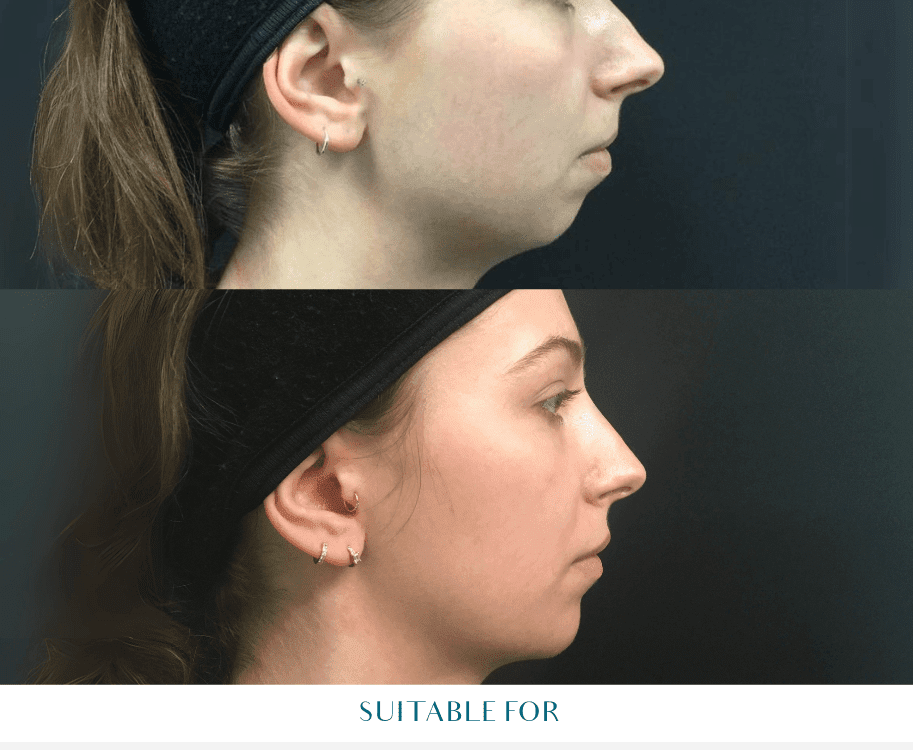 jawline fillers