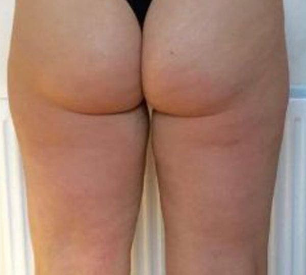 lipofirm pro after