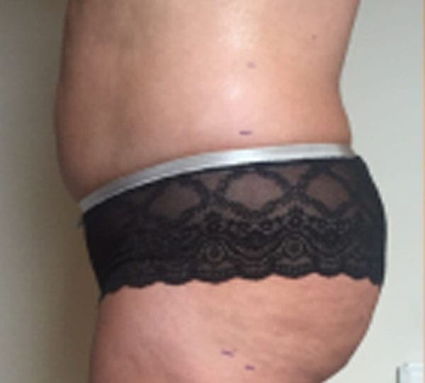 lipofirm after