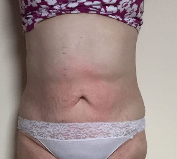body contouring after