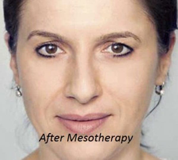 mesotherapy treatment after